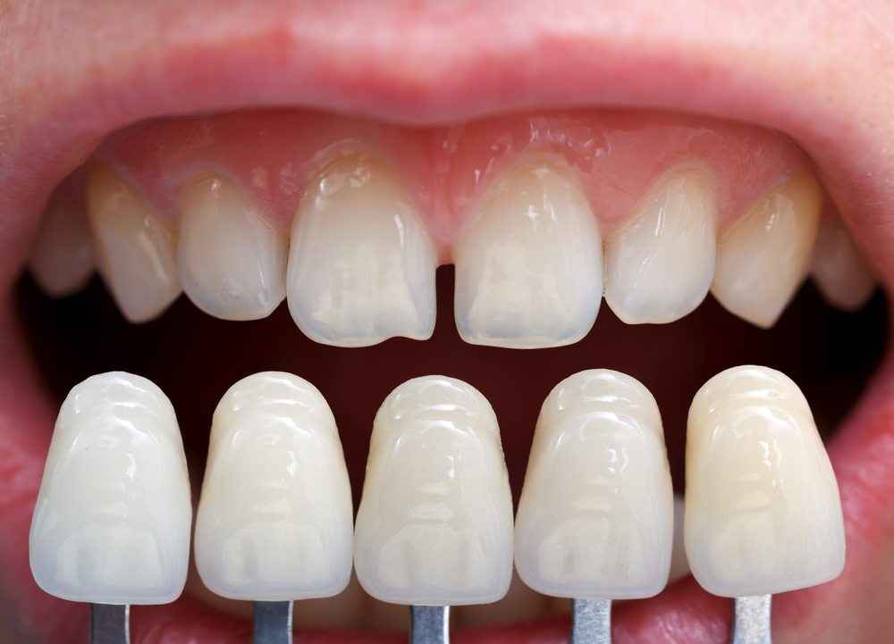 Especialista esclarece todas as dúvidas sobre Lentes de Porcelana Dental