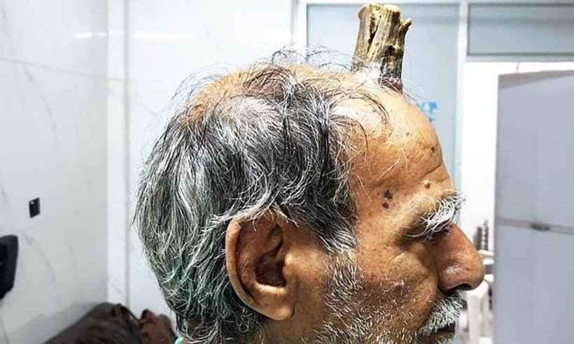 Homem tem 'chifre' de 10 centímetros removido em cirurgia - Divulgação/Goal Post Media