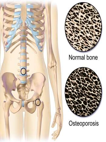 Entenda como prevenir a osteoporose - Reprodução 