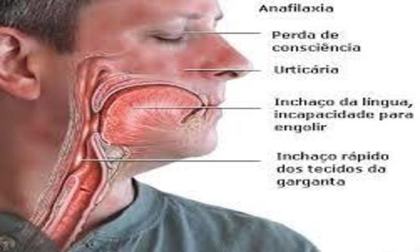 Entenda o que é anafilaxia, reação alérgica que pode levar à morte em poucos minutos - Reprodução