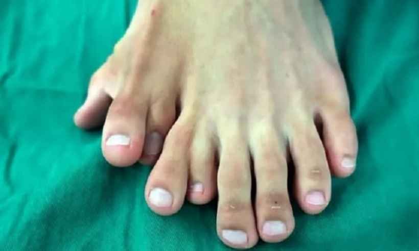 Com nove dedos no pé, homem faz cirurgia para remoção - Reprodução/Asia Wire
