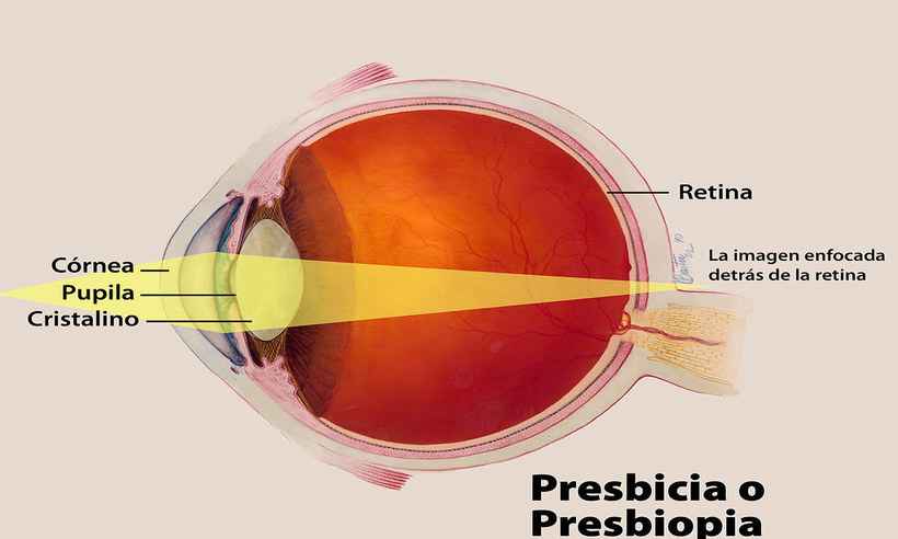 Entenda o que é presbiopia, popularmente conhecida como vista cansada - Reprodução