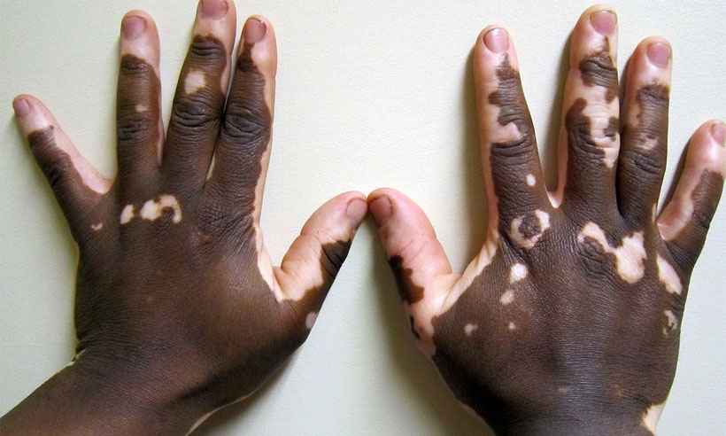 Justiça proíbe eliminação de candidatos com vitiligo em concursos da PM e Bombeiros - James Heilman,MD