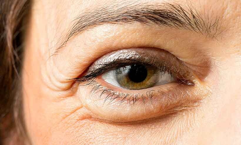 Tem bolsas abaixo dos olhos? Saiba como eliminá-las - Reprodução da Internet