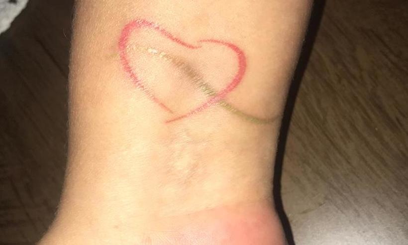 Paciente curada de câncer de mama tatua logomarca do hospital - Arquivo pessoal
