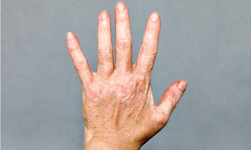É possível tratar e controlar o vitiligo - Wikimidia/Reprodução