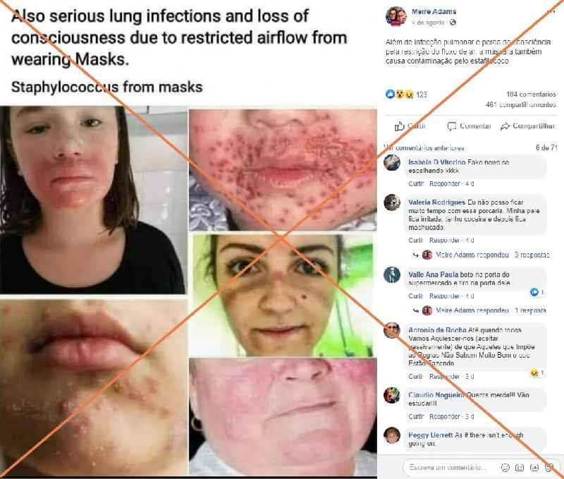 Checamos: fotos mostram doenças de pele; só duas têm relação com máscaras