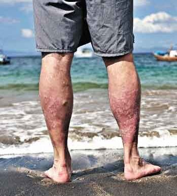 Doenças dermatológicas podem ser detectadas por fitas adesivas - Ralf Tooten Photographer/Pfizer/Divulgação