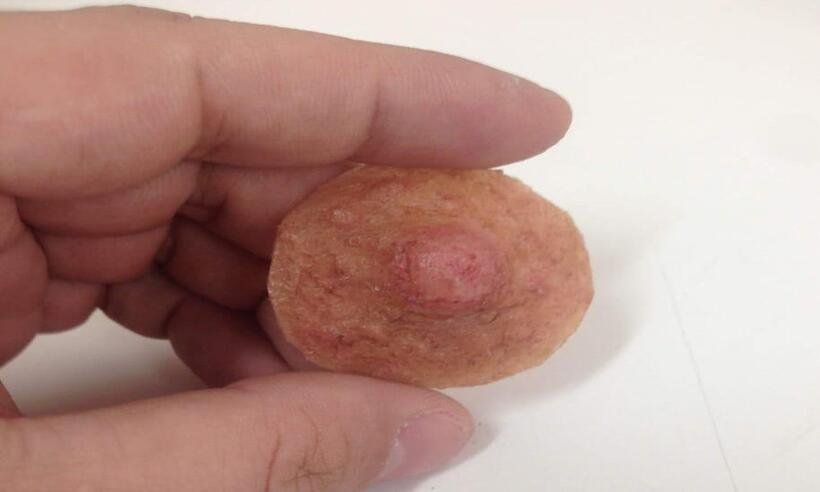 Recobrando a autoestima: mulheres mastectomizadas ganham prótese de aréola/mamilo - Infinita/Divulgação