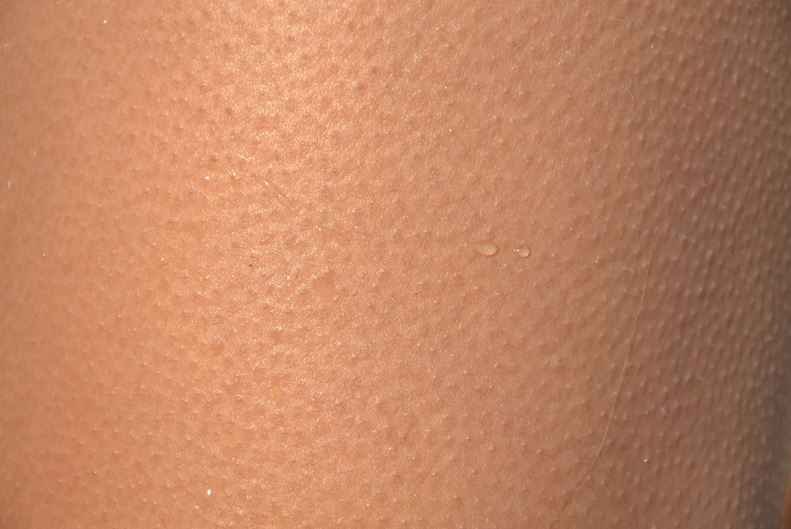 Alerta: Coronavírus sobrevive na pele cinco vezes mais que a gripe, diz estudo - PxHere