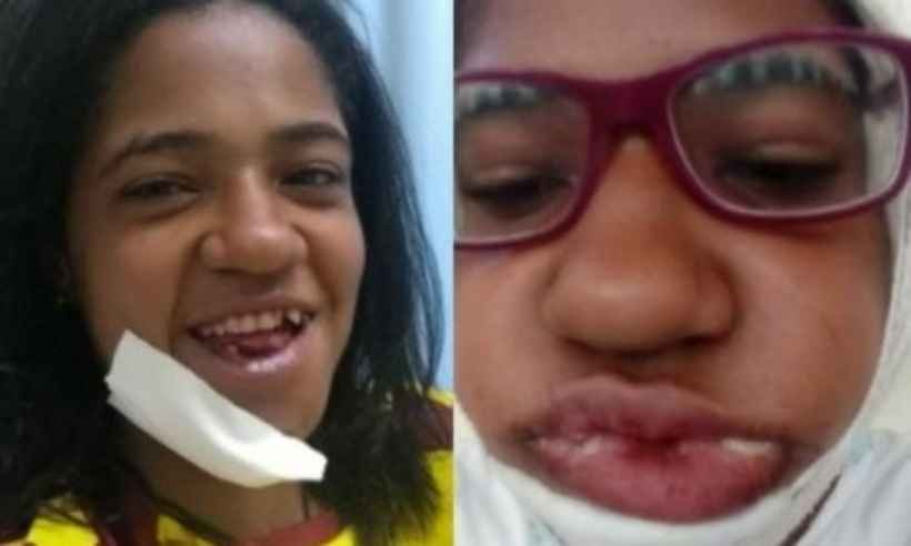 Jovem de Ouro Preto faz vaquinha on-line para tratar danos provocados por um tombo - Divulgação/ Joyce Pedro