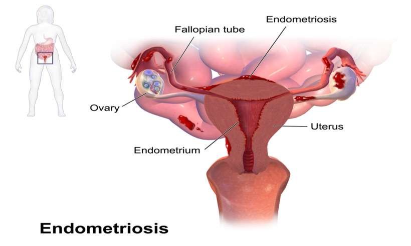 Campanha oferece atendimento às mulheres com endometriose - Wikimedia Commons