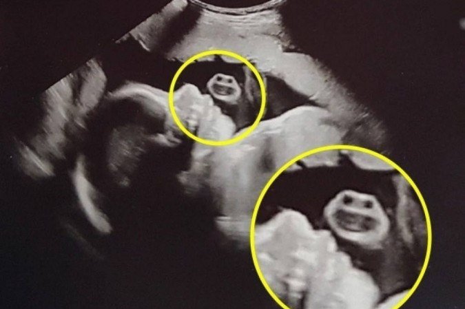 Tartaruga ninja? Imagem de ultrassom na barriga da mãe viraliza nas redes - Reprodução/Facebook