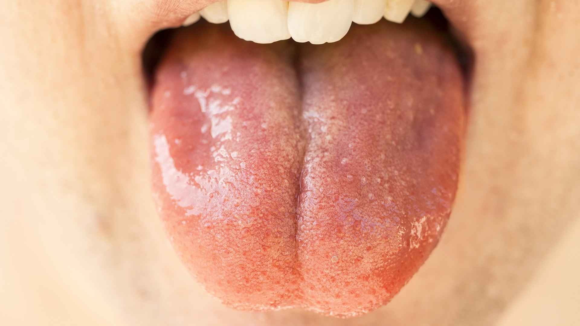 COVID-19 infecta e se replica nas glândulas salivares - Pixabay