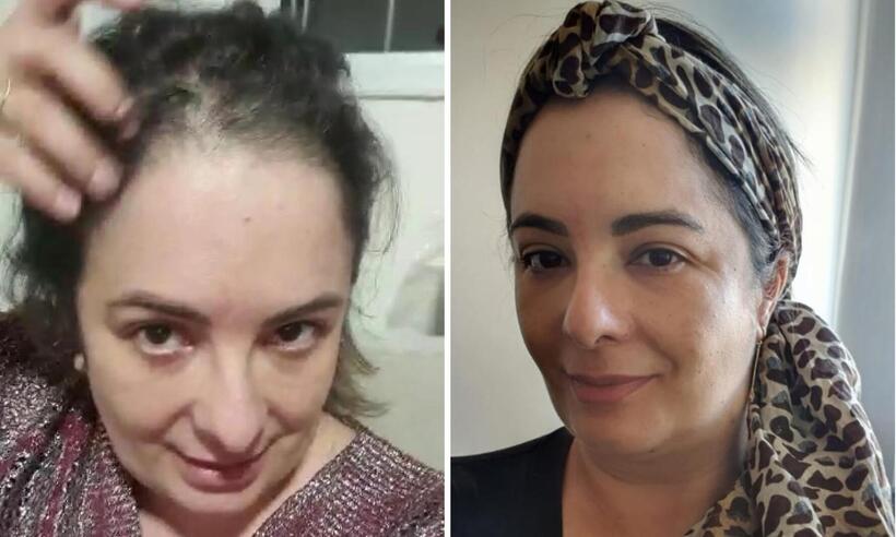 Mulheres relatam a dificuldade em lidar com a queda de cabelo no pós-COVID - Reprodução/Redes sociais