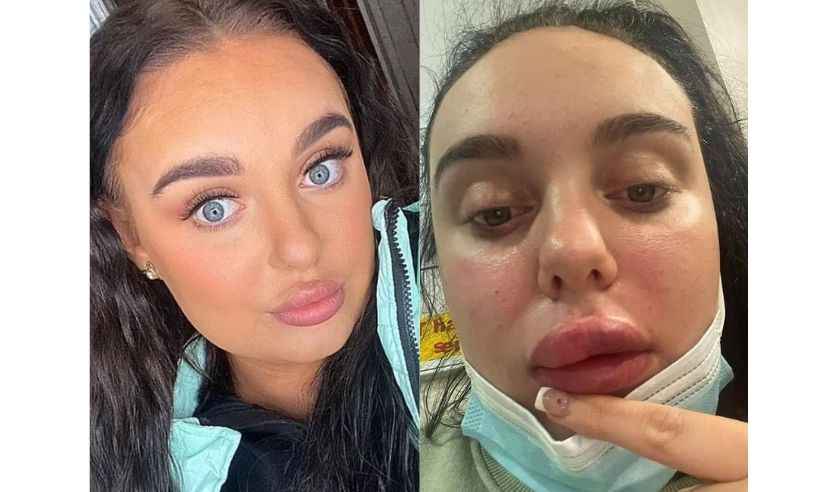 Por conta de um preenchimento labial, jovem de 21 anos quase perde a visão  - Arquivo Pessoal/Reprodução 
