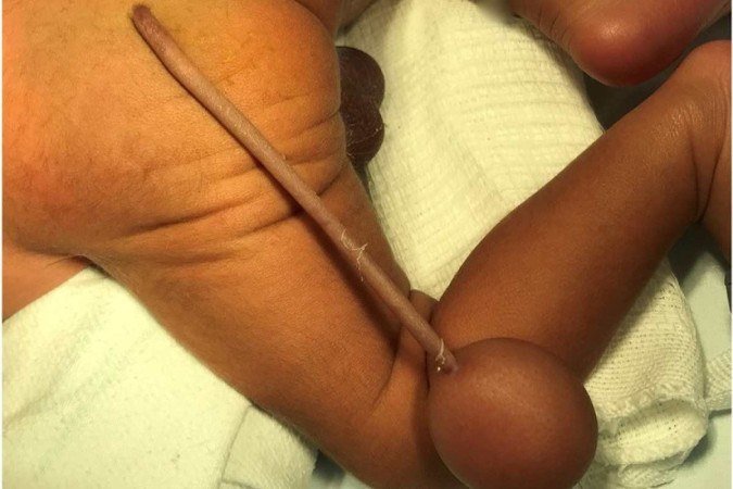 Jornal científico divulga caso brasileiro de bebê que nasceu com 'cauda' - Reprodução/Journal of Pediatric Surgery Case Reports