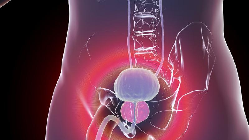 Aumento benigno da próstata: condição tem sido confundida com câncer