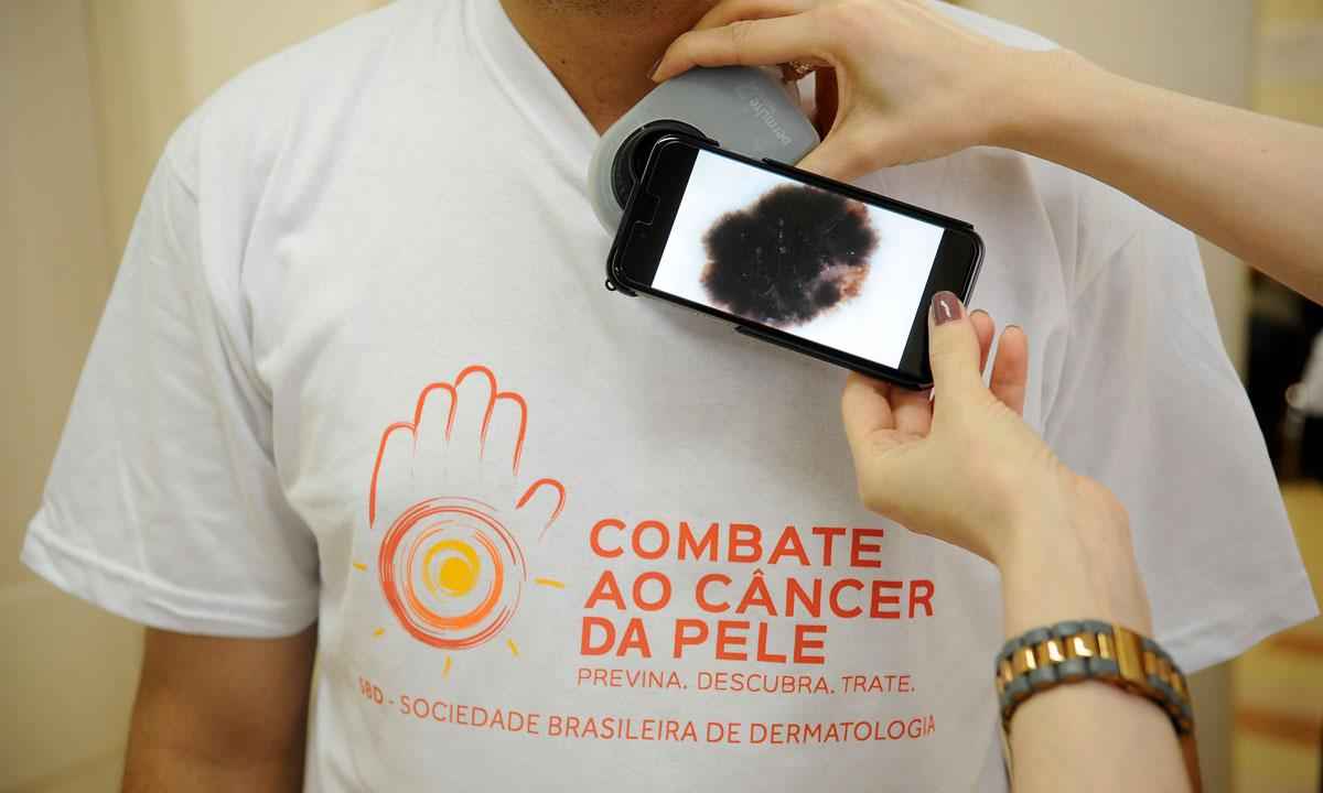 Brasil deixou de diagnosticar 17,2 mil casos de câncer de pele em 2020 - Fernando Brazão/divulgação