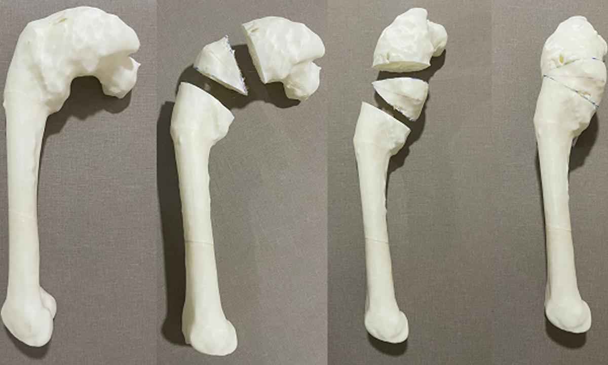 HC-UFTM inicia cirurgias ortopédicas a partir de programação em 3D - UFTM/Divulgação