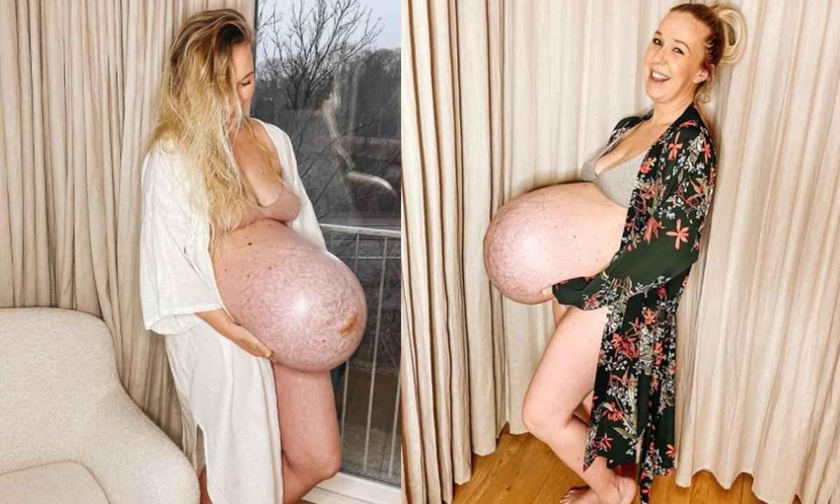 Entenda o que causou as marcas na barriga da influenciadora na gravidez - Reprodução Instagram