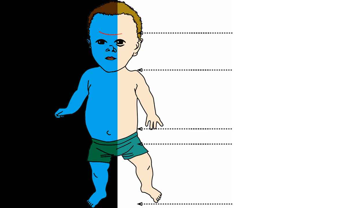 Conheça a acondroplasia, doença que pode levar à morte súbita do bebê
