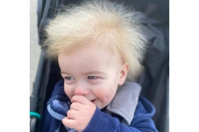 O que é 'cabelo impenetrável'? síndrome transformou bebê em celebridade - uncombable_locks/Instagram/Reprodução