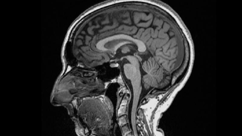 Exames de imagem revelam como o coronavírus pode alterar o cérebro - UK Biobank