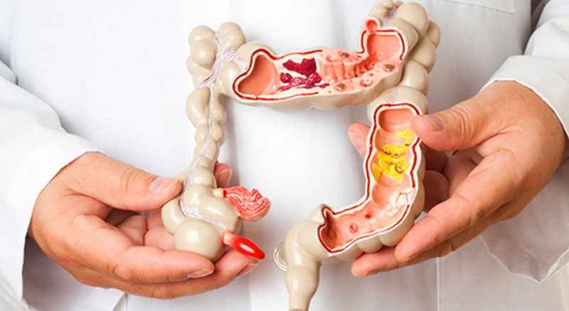 Câncer colorretal: quase 1 milhão de exames de prevenção não foram  feitos - Sociedade Brasileira de Cancerologia/Divulgacao 