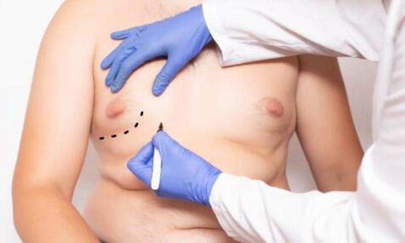 Ginecomastia: homens têm mama aumentada -  Clínica Sabath/Divulgação
