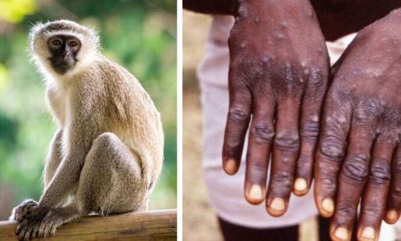 Varíola do macaco: saiba o que é, como é transmitida e qual a gravidade - AFP