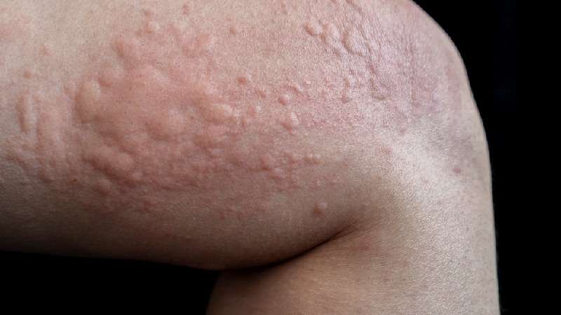 Urticaria/allergy -  (crédito: Getty Images)