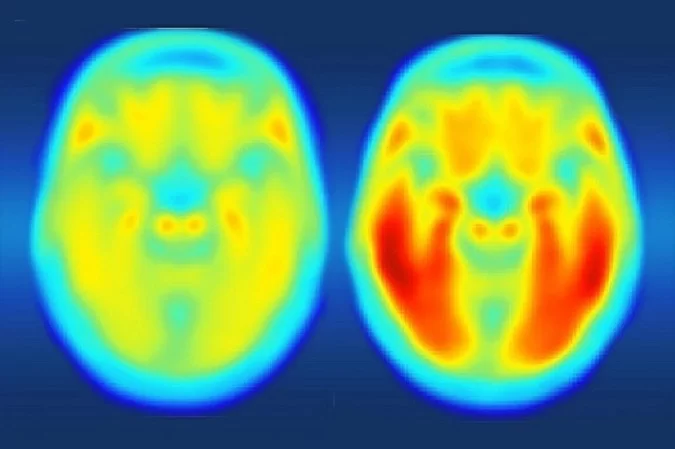 Estudo apresenta nova tese para origem do Alzheimer