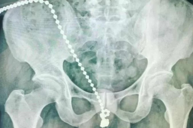 Homem precisa de cirurgia no pênis depois de introduzir corrente na uretra - Divulgação/ Universidade Médica de Taipé