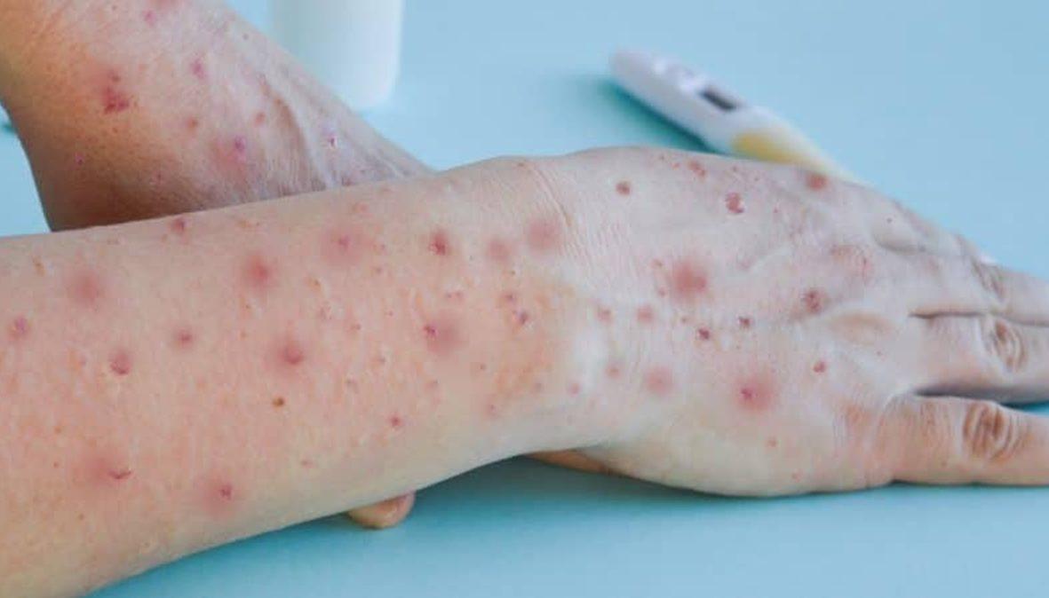Sete Lagoas confirma dois casos de varíola dos macacos - Reprodução/Pixabay