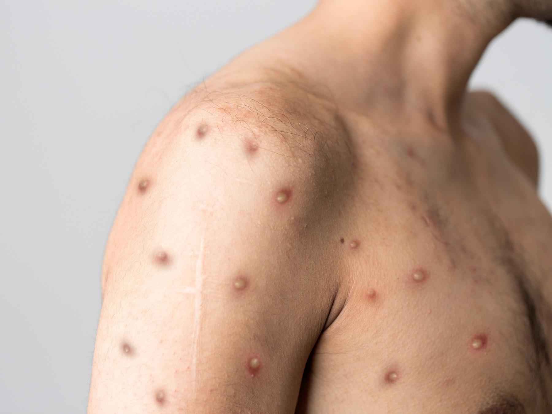 Governador Valadares confirma primeiro caso de varíola dos macacos - Reprodução/Pixabay