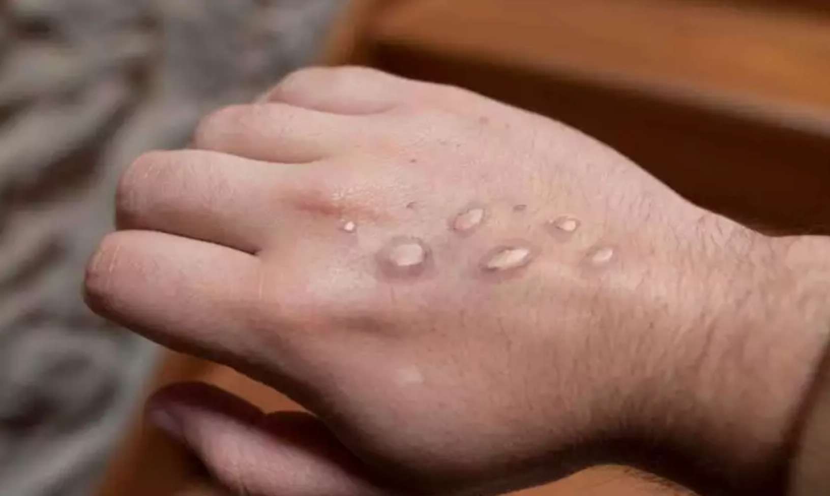 Varíola dos macacos: Minas ultrapassa 100 casos confirmados de monkeypox - iStock/Imagem ilustrativa
