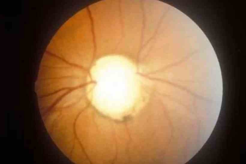  Terapia com gene consegue curar cegueira, mostra estudo - International Centre for Eye Health/Divulgação