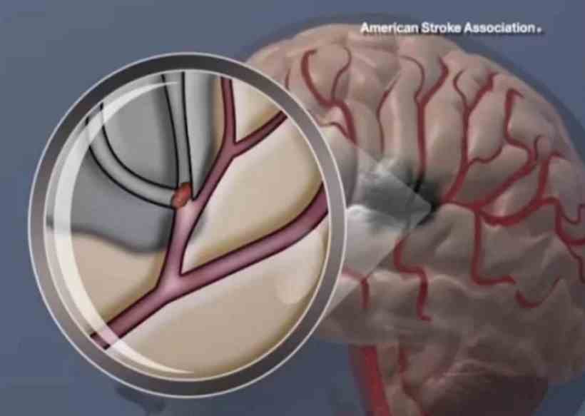 Imagens gravadas em smartphone conseguem detectar risco de AVC - Divulgação/American Heart Association