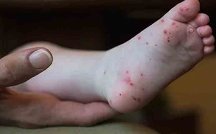 Gripe do tomate: infecção surge na Índia e preocupa autoridades em saúde - CDC/Reprodução