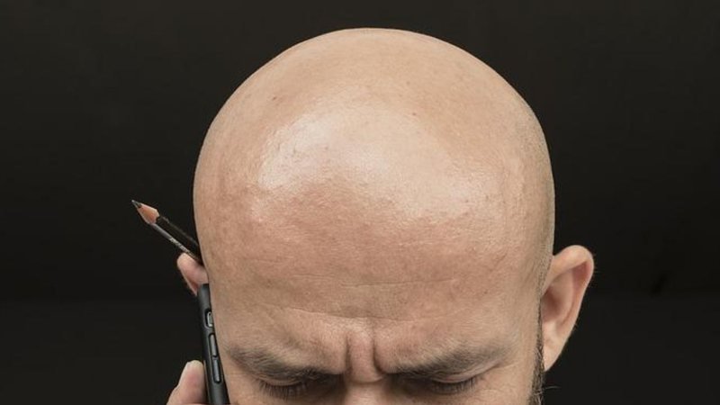 Minoxidil não é indicado para queda de cabelo pós-COVID - Pixabay