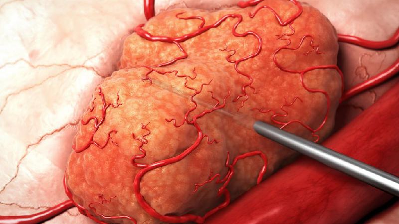 Nova radioterapia é promissora contra tumores preservando tecido saudável; entenda - Divulgação