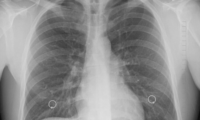 Tuberculose: Brasil é o 2º país do mundo em mortes, diz a OMS - agem de oracast por Pixabay 