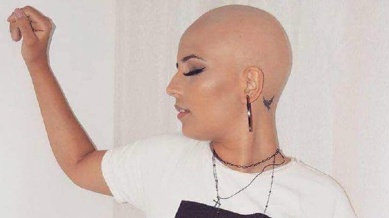 Cabeleireira mineira com alopecia fica careca: 'Perdi os fios e clientes'