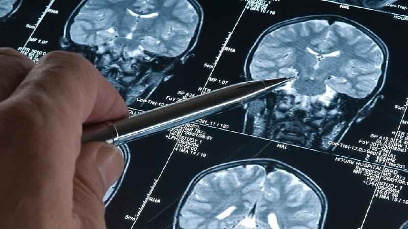 Medicamento experimental contra Alzheimer tem resultados 'históricos' - Getty Images