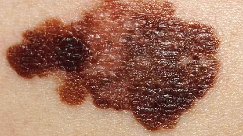 Câncer de pele: como identificar pintas, manchas e outros sinais  - Getty Images