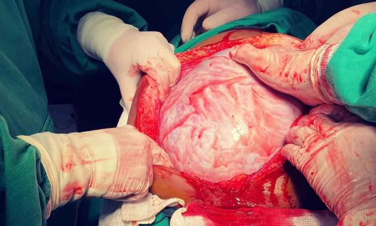 Médicos retiram massa ovariana de 13kg de mulher, em Turmalina - Divulgação