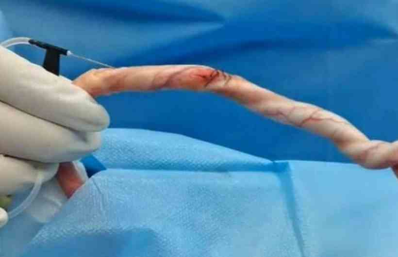 Tecido artificial restaura lesões penianas e recupera função erétil - Xuetao Shi et al/Divulgação