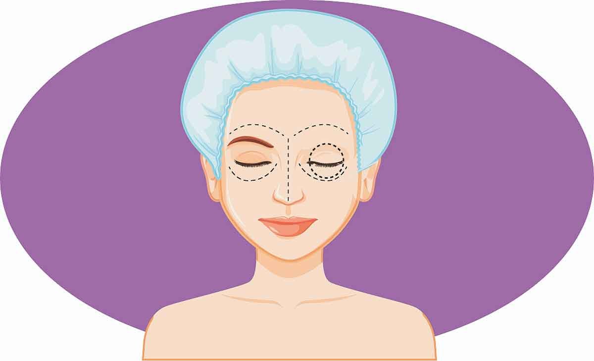 Mitos e verdades sobre a cirurgia plástica das pálpebras