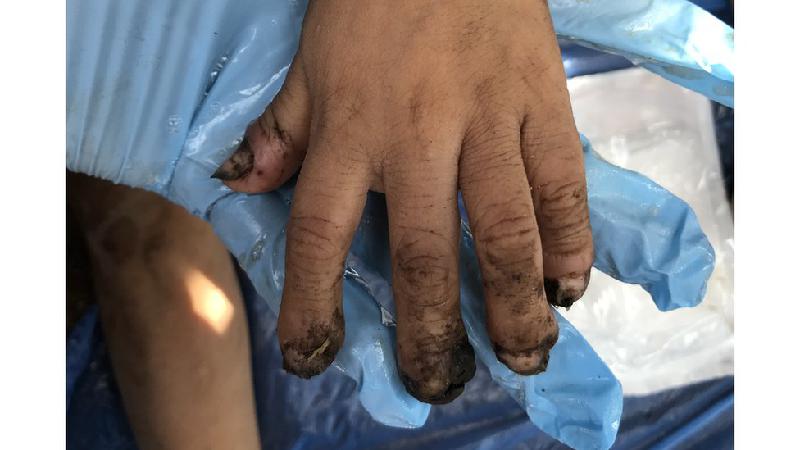 O que é tungíase, o 'bicho de pé' que faz yanomamis sofrerem amputações  - Arquivo pessoal/ Carla C F Rodrigues